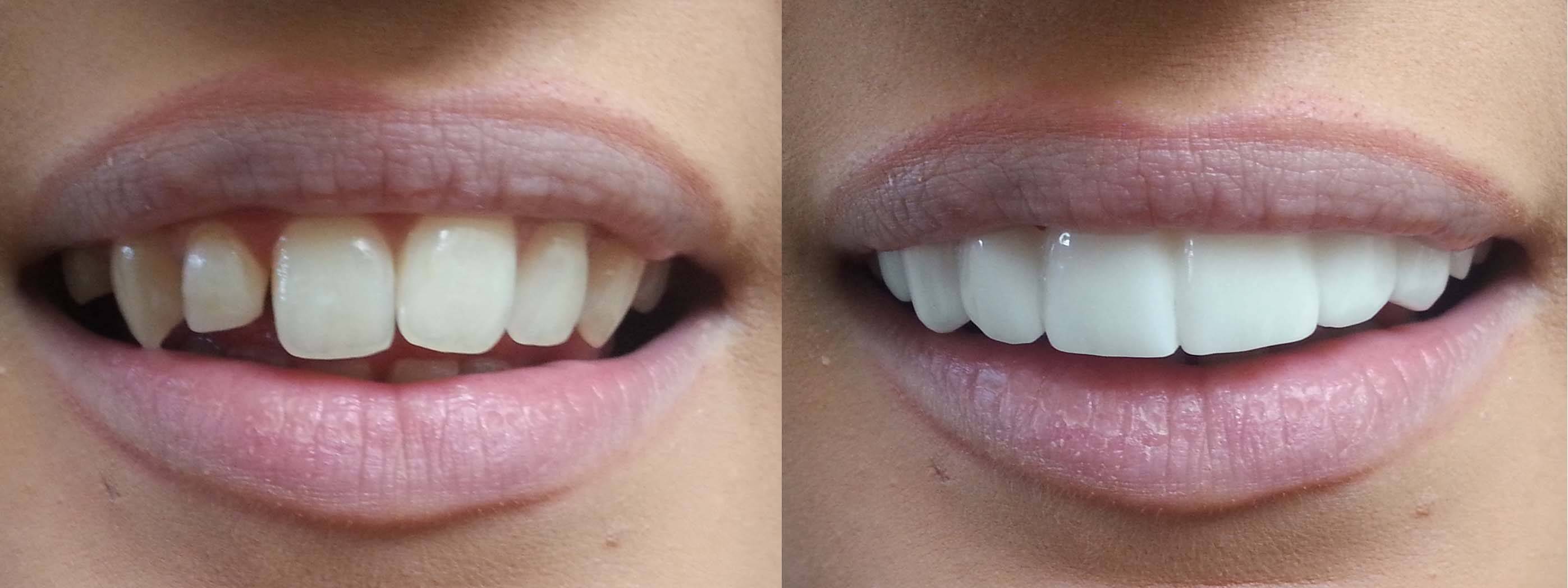 veneers porcelain veneer dental tooth before clip much laminate caps shade cosmetic bleach treatment crowns